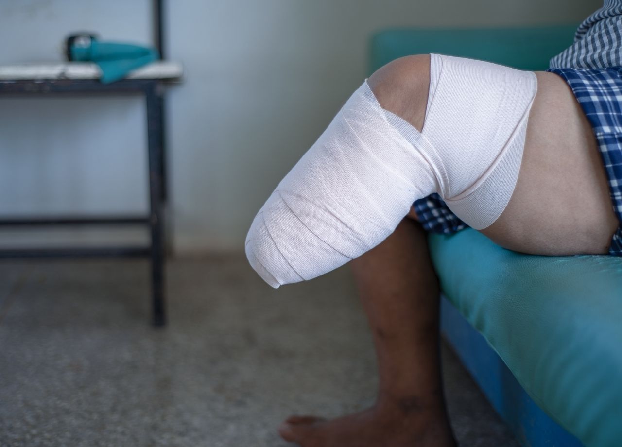 Amputation Injury Lawyer